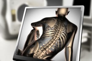 Vegan Diet is Associated with Low Bone Mineral Density