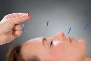 acupuncture