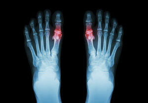 Herbal Chuanhutongfeng Mixture Improves Chronic Gouty Arthritis